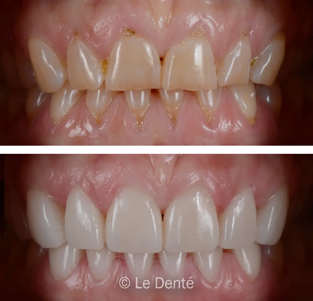 before and after dental smile makeover