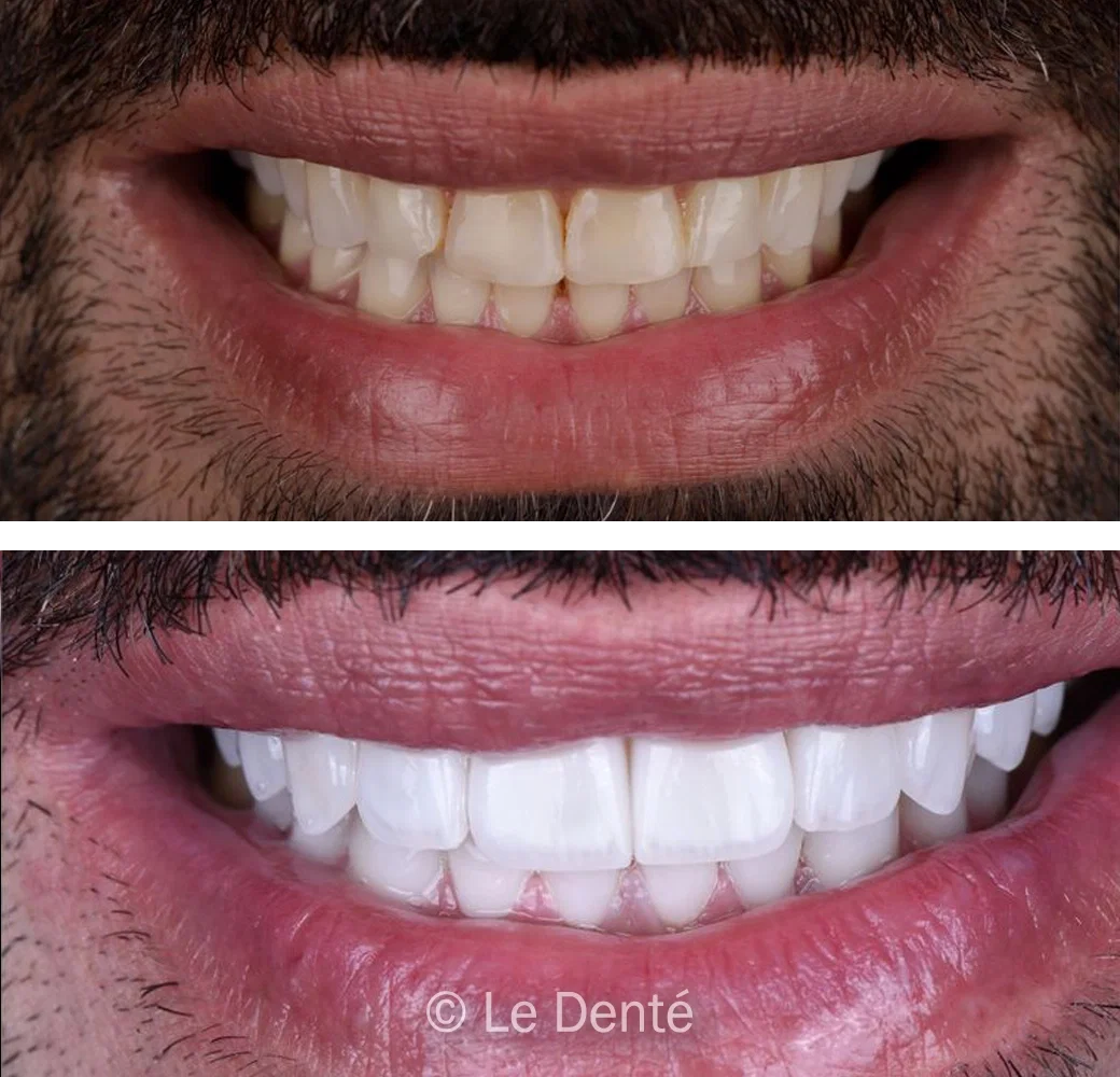 before and after neuromuscular dentistry