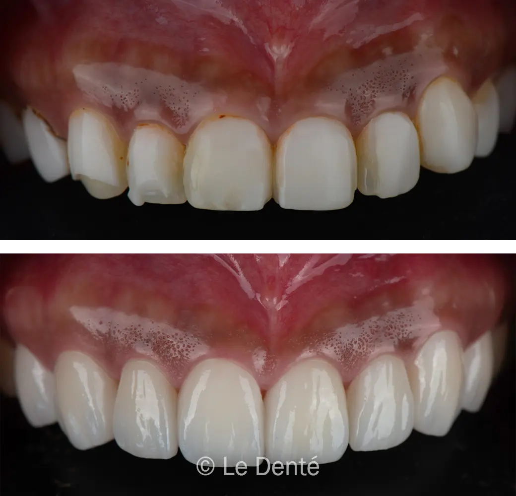 before and after teeth whitening