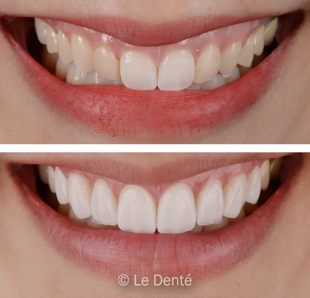 before and after dental implant