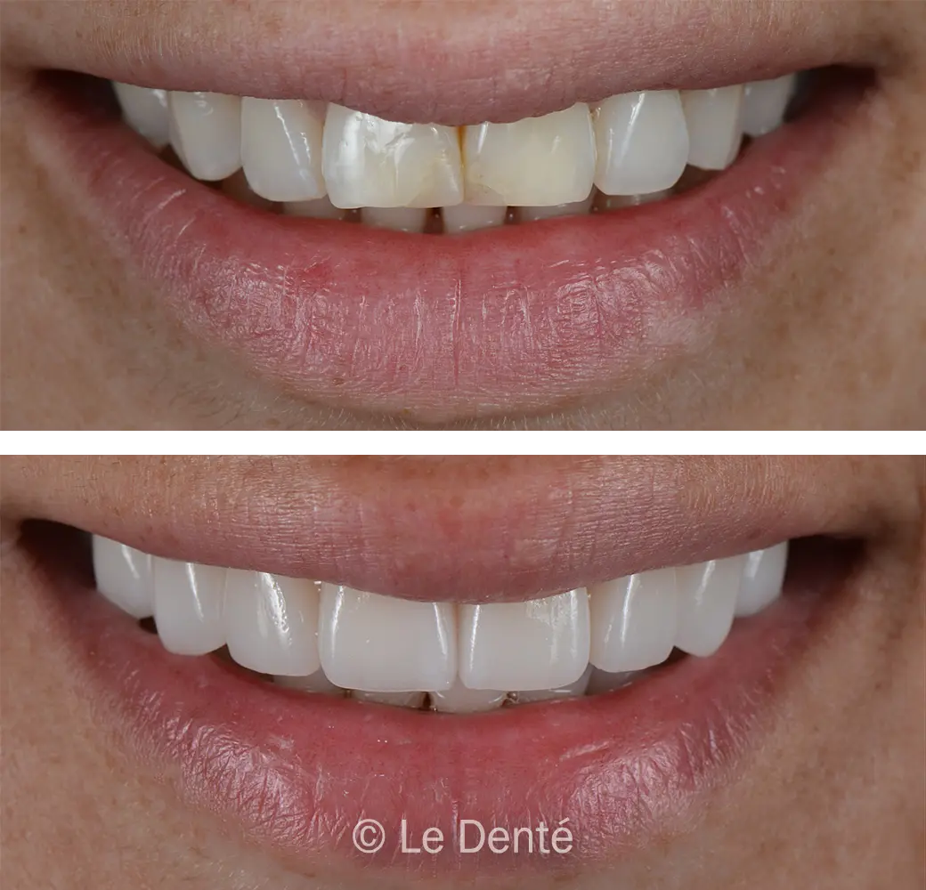 before and after orthodontic braces