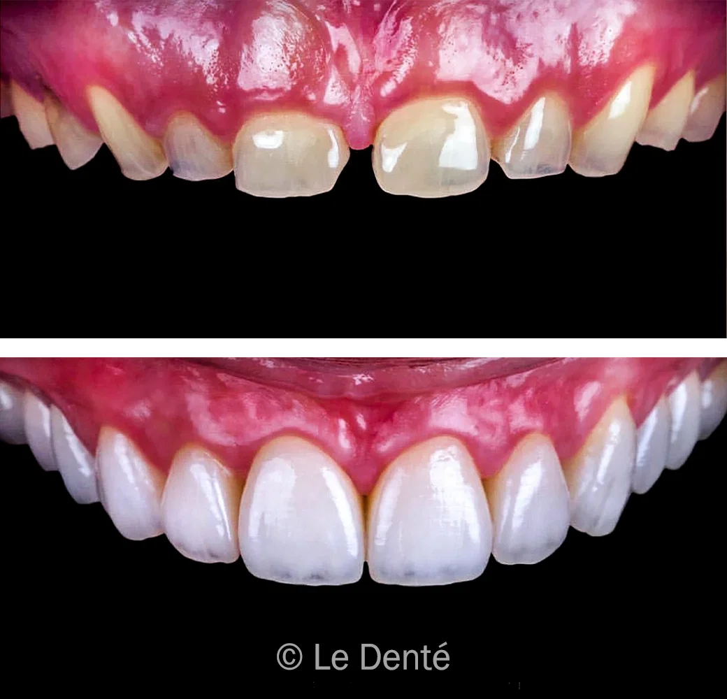 before and after full mouth rehabilitation