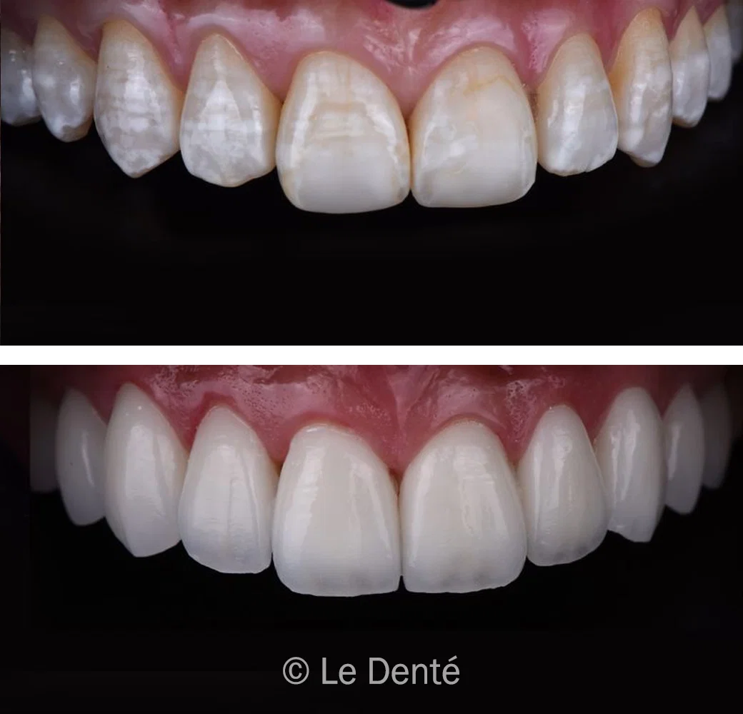before and after gum treatment
