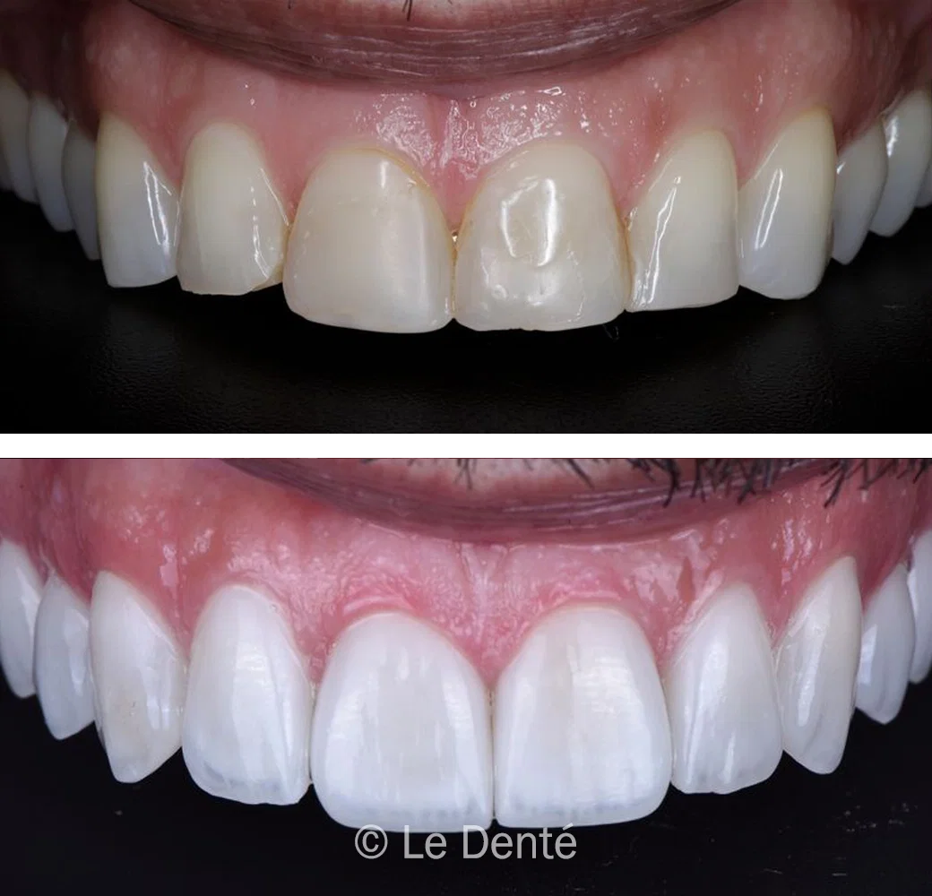 before and after root canal treatment