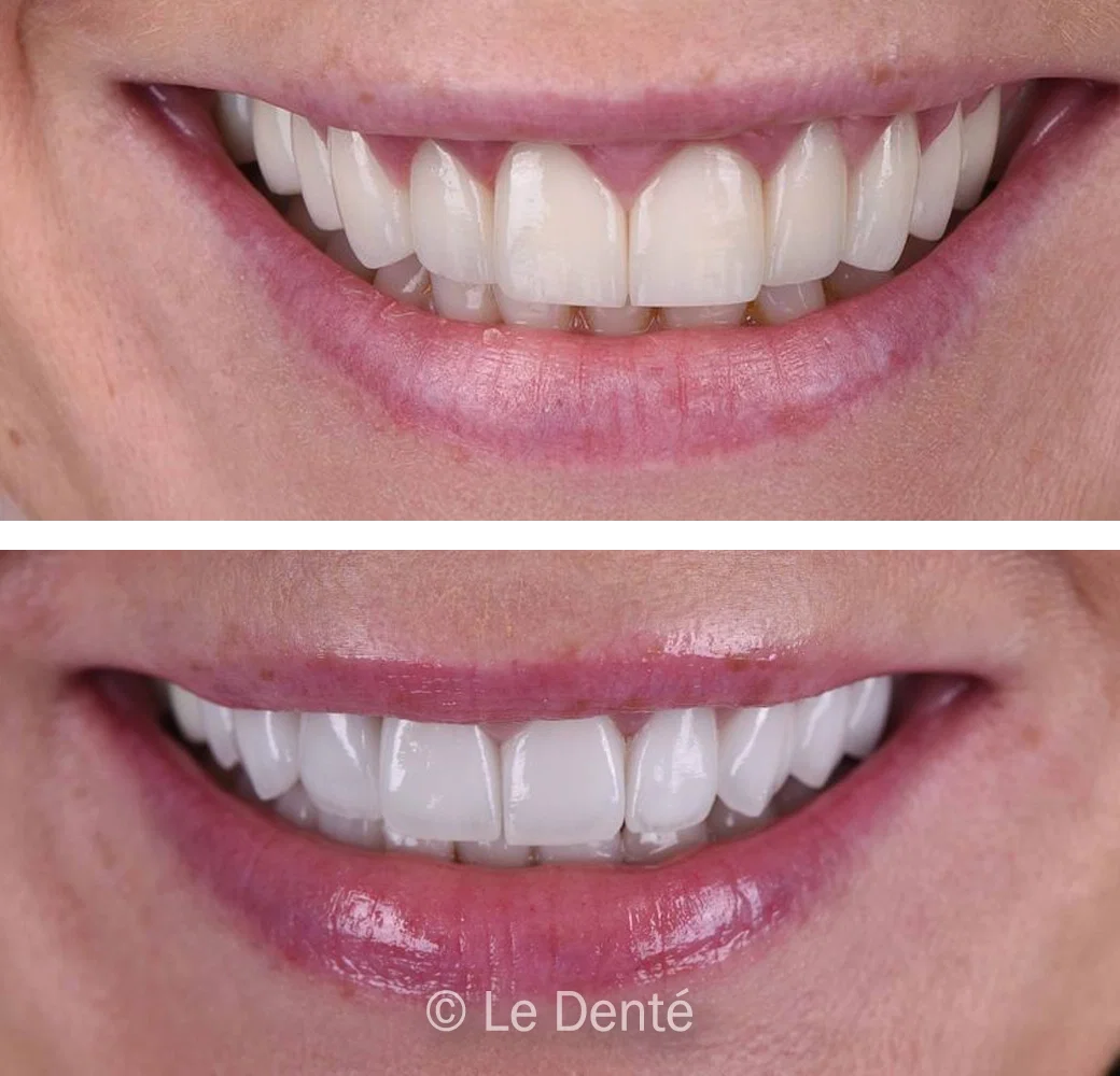 before and after hollywood smile