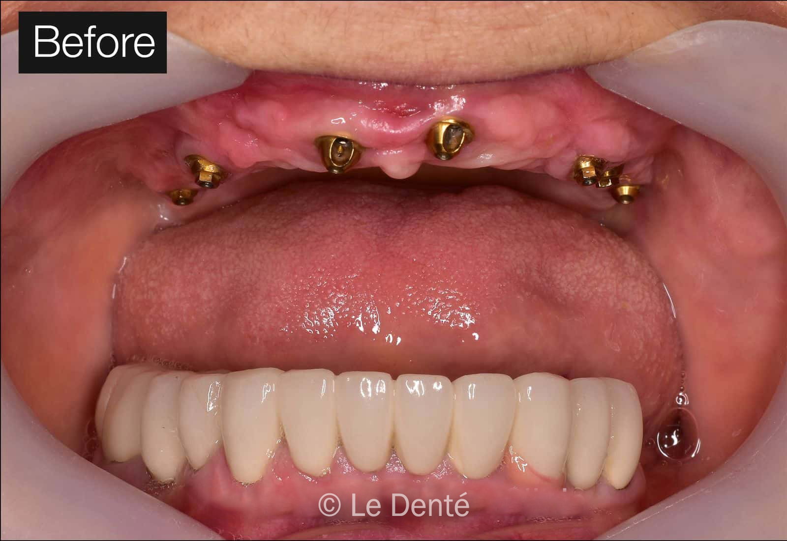 Dental Implants in Dubai